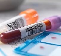 Diagnóstico de prostatitis de laboratorio