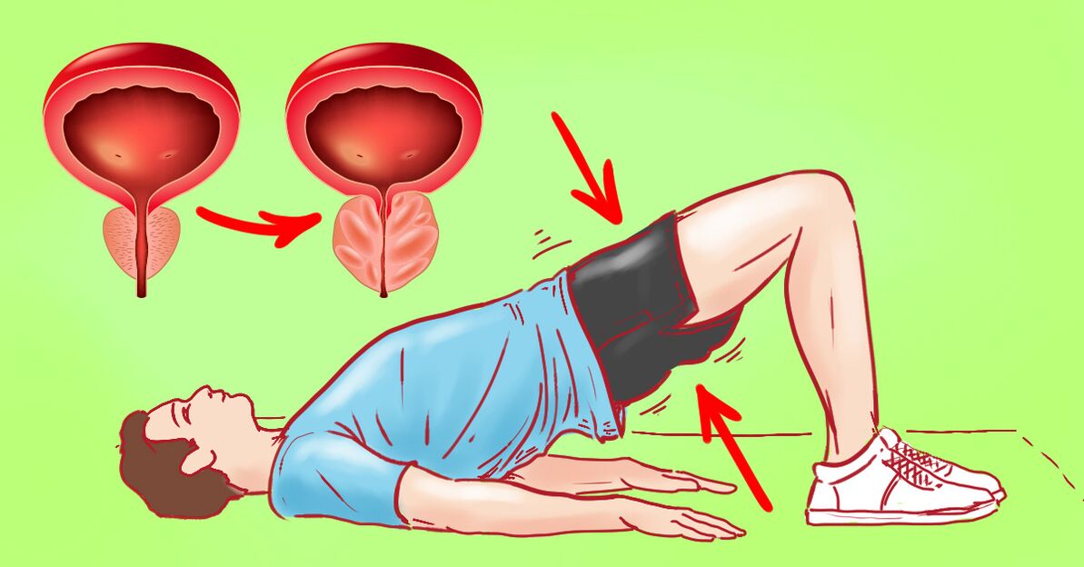 Ejercicios terapéuticos para prostatitis crónica
