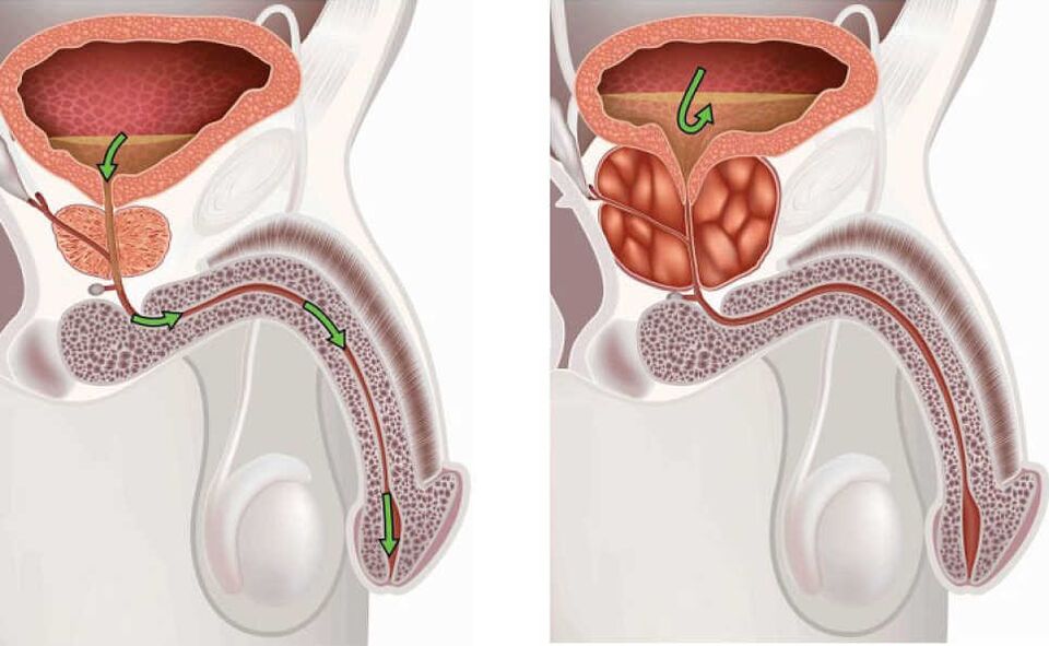 Inflamación de la glándula próstata