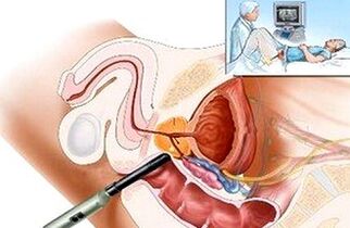Formas de diagnosticar prostatitis