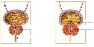 Tipos y formas de prostatitis en hombres