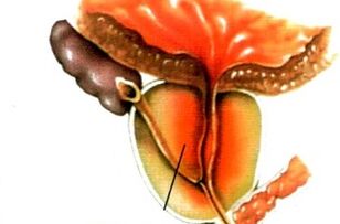 ¿Qué es la prostatitis en los hombres