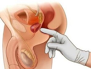 Masaje prostático para el tratamiento de la prostatitis en hombres.