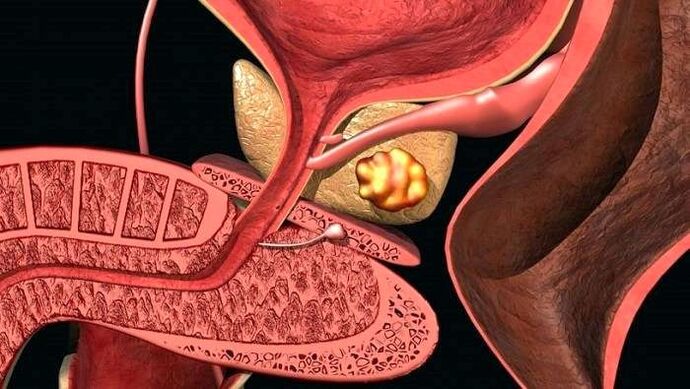 Depósitos de cálculos en la próstata con prostatitis calculosa.