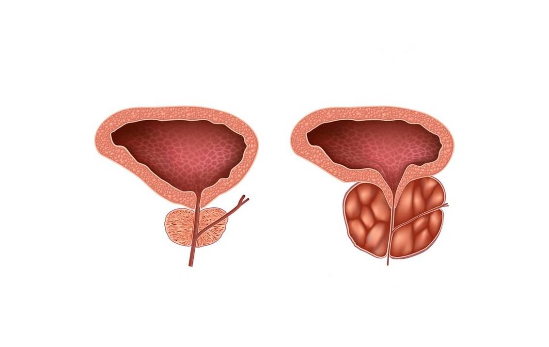 síntomas de prostatitis en hombres