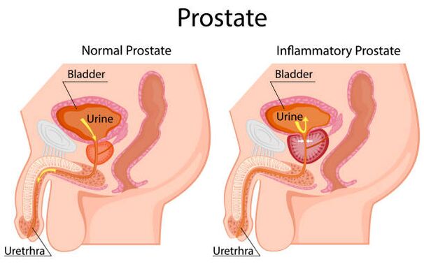 próstata sana e inflamada