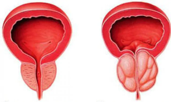 Próstata normal (izquierda) y prostatitis crónica inflamada (derecha)