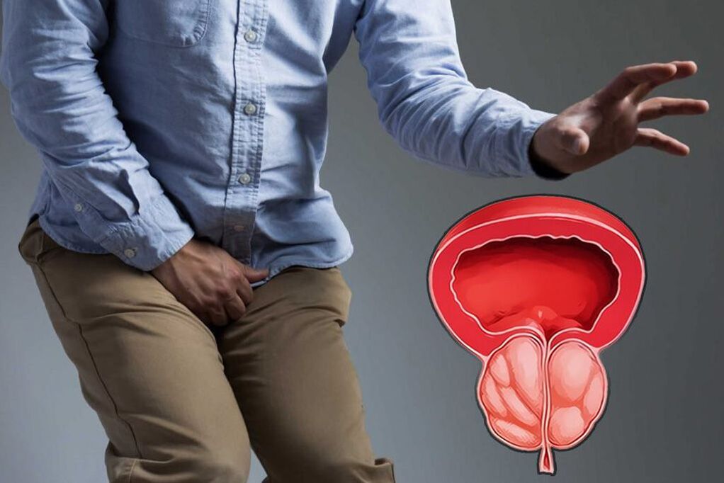 próstata aguda en hombres