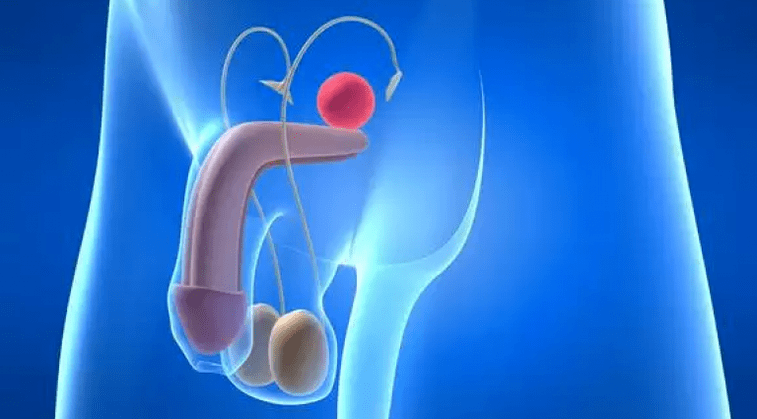 La prostatitis es una inflamación de la glándula prostática en los hombres que requiere un tratamiento complejo. 
